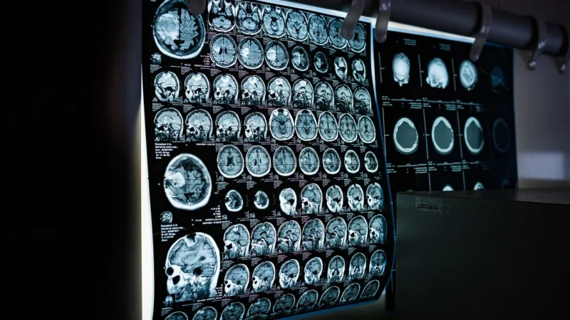 Najnowsze osiągnięcia w leczeniu chorób neurologicznych